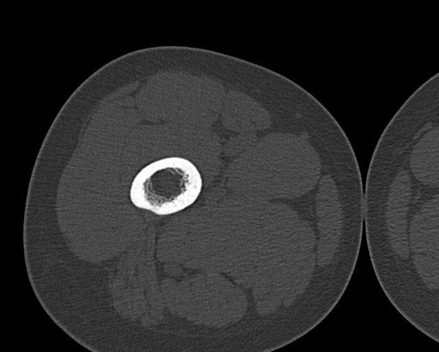 File:Chronic ostemyelitis of the femur with long sinus tract (Radiopaedia 74947-85982 Axial bone window 57).jpg