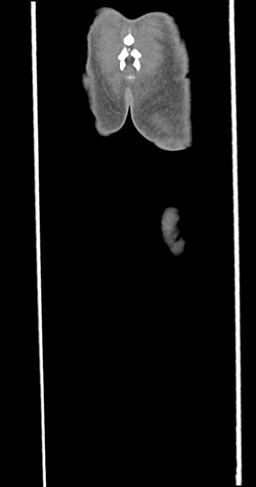 Chronic osteomyelitis (with sequestrum) (Radiopaedia 74813-85822 E 57).jpg