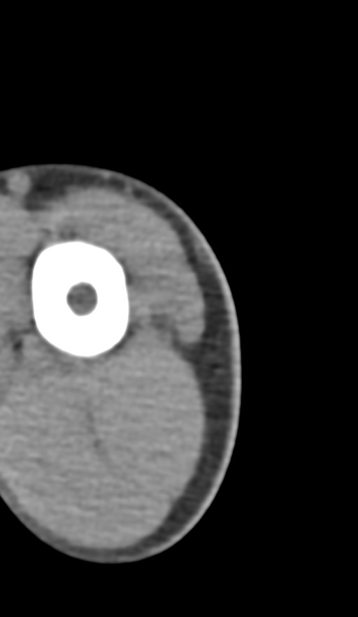 Chronic osteomyelitis of the distal humerus (Radiopaedia 78351-90971 Axial non-contrast 10).jpg
