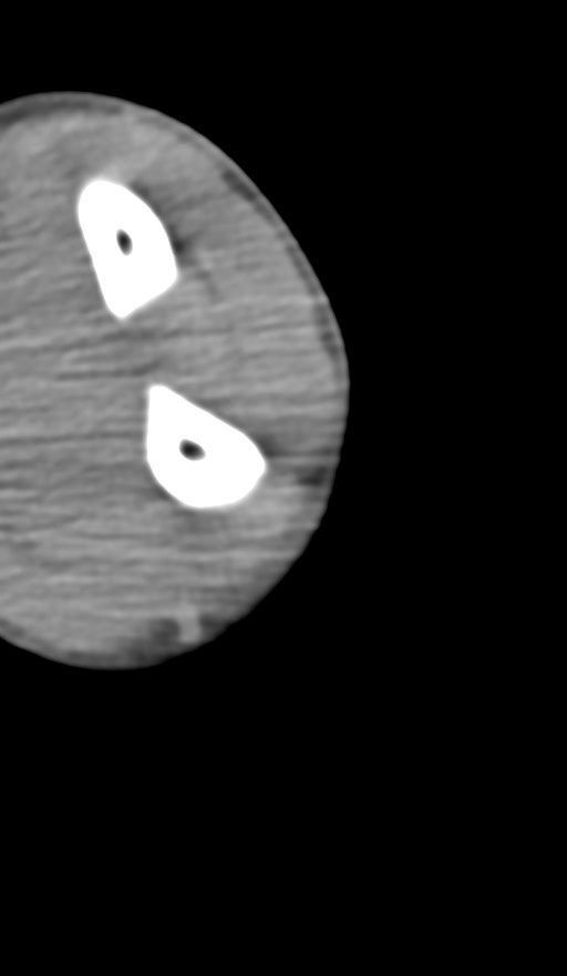Chronic osteomyelitis of the distal humerus (Radiopaedia 78351-90971 Axial non-contrast 132).jpg