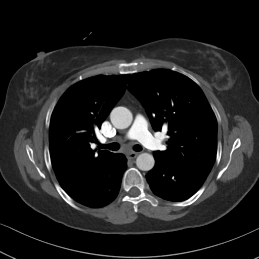 Chronic pulmonary embolus (Radiopaedia 39129-41341 Axial C+ CTPA 44).png