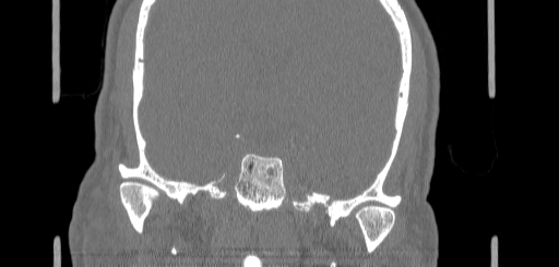 Chronic sphenoidal sinusitis (Radiopaedia 62030-70122 Coronal bone window 143).jpg
