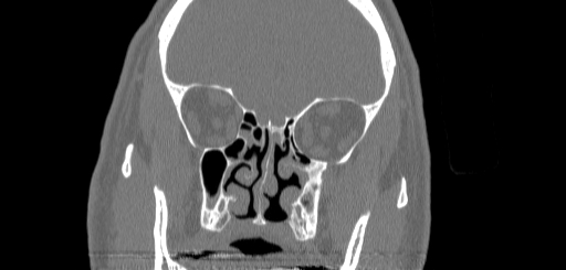 Chronic sphenoidal sinusitis (Radiopaedia 62030-70122 Coronal bone window 75).jpg