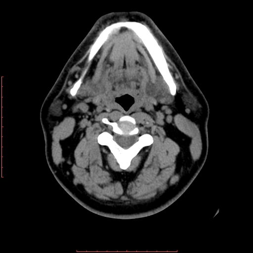 Chronic submandibular sialolithiasis (Radiopaedia 69817-79814 Axial non-contrast 112).jpg