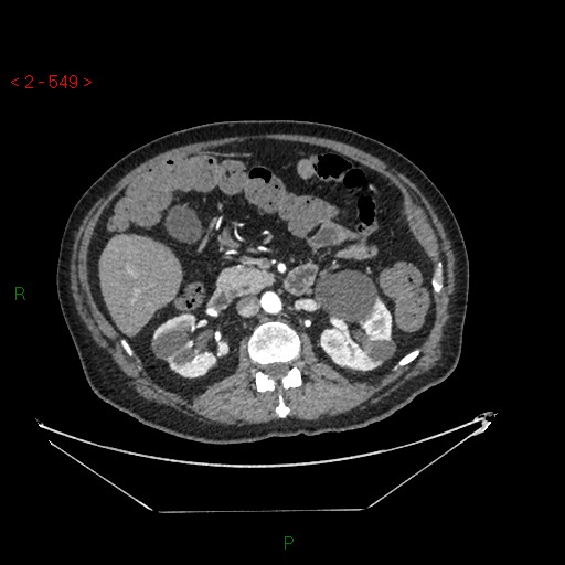 File:Circumaortic left renal vein and doubled left renal arteries (Radiopaedia 52268-58158 A 85).jpg