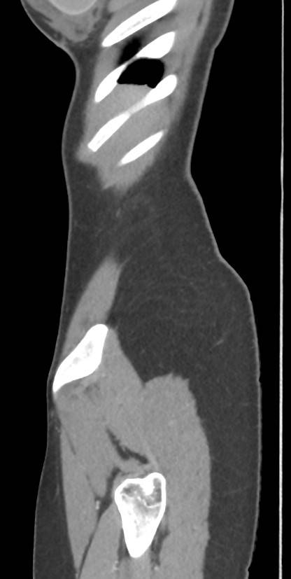 Circumaortic left renal vein with a duplicated retroaortic vein (Radiopaedia 91668-109398 C 3).jpg