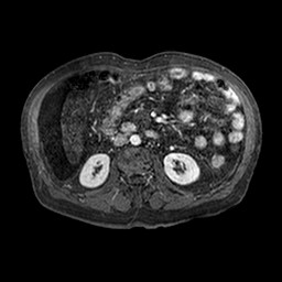 Cirrhosis and hepatocellular carcinoma in the setting of hemochromatosis (Radiopaedia 75394-86594 Axial T1 C+ fat sat 186).jpg
