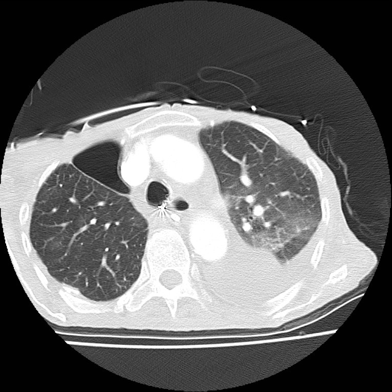 Clagett thoracotomy with bronchopleural fistula (Radiopaedia 29192-29587 Axial lung window 16).jpg