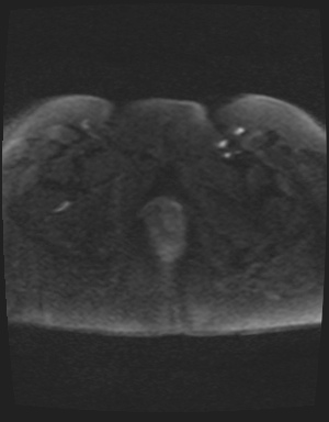 Class II Mullerian duct anomaly- unicornuate uterus with rudimentary horn and non-communicating cavity (Radiopaedia 39441-41755 Axial DWI 60).jpg