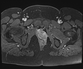 File:Class II Mullerian duct anomaly- unicornuate uterus with rudimentary horn and non-communicating cavity (Radiopaedia 39441-41755 Axial T1 fat sat 124).jpg