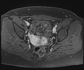 File:Class II Mullerian duct anomaly- unicornuate uterus with rudimentary horn and non-communicating cavity (Radiopaedia 39441-41755 Axial T1 fat sat 72).jpg