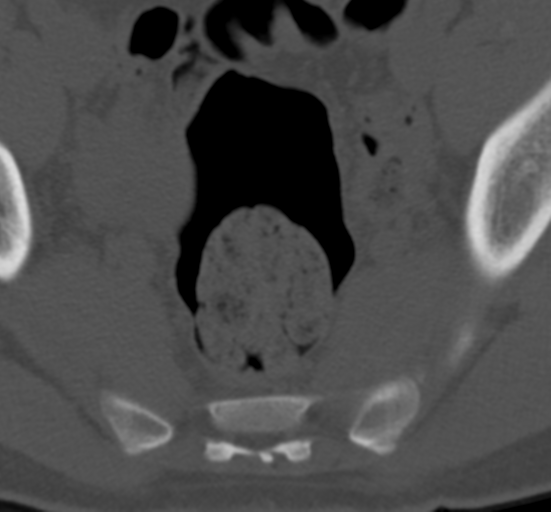 Clear cell meningoma - lumbar spine (Radiopaedia 60116-67691 Axial bone window 85).png