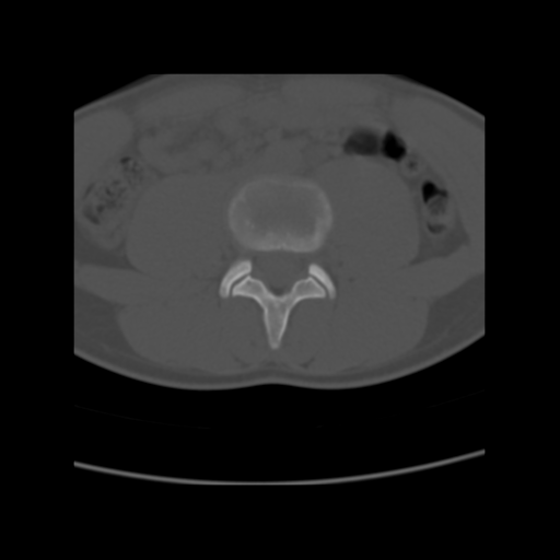 File:Clear cell meningoma - lumbar spine (Radiopaedia 60116-67691 Sagittal bone window 1).png