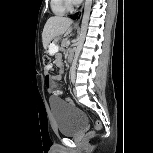 File:Closed-loop small bowel obstruction (Radiopaedia 73713-84509 B 92).jpg