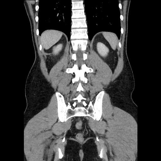 Closed-loop small bowel obstruction (Radiopaedia 73713-84509 C 96).jpg