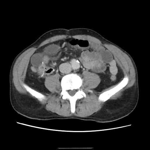 Closed loop small bowel obstruction (Radiopaedia 59227-66554 A 53).jpg
