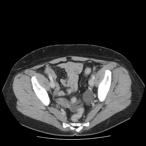 File:Closed loop small bowel obstruction (Radiopaedia 65403-74451 Axial 42).jpg