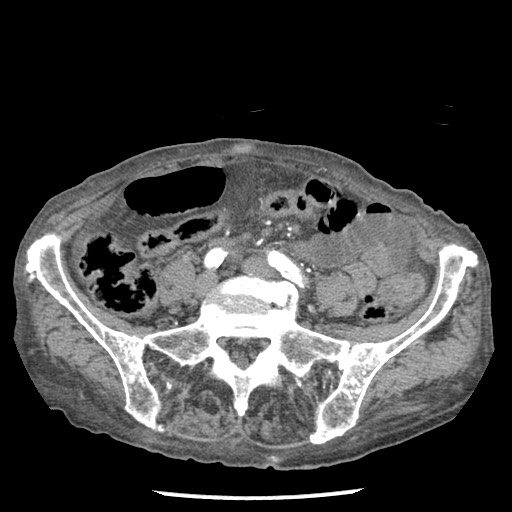 File:Closed loop small bowel obstruction - adhesions and infarct (Radiopaedia 85125-100678 A 121).jpg