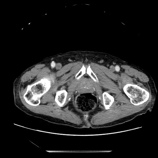 Closed loop small bowel obstruction - adhesive disease and hemorrhagic ischemia (Radiopaedia 86831-102990 A 180).jpg
