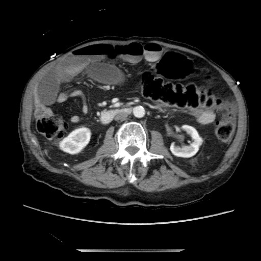 Closed loop small bowel obstruction - adhesive disease and hemorrhagic ischemia (Radiopaedia 86831-102990 A 93).jpg