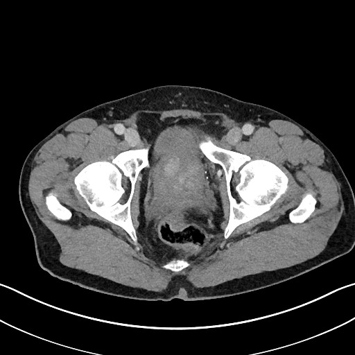 Closed loop small bowel obstruction - internal hernia (Radiopaedia 57806-64778 B 121).jpg