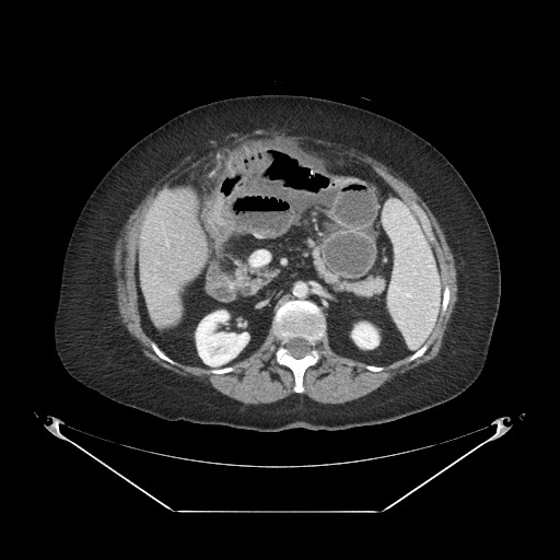 Closed loop small bowel obstruction - internal hernia (Radiopaedia 65402-74450 A 46).jpg