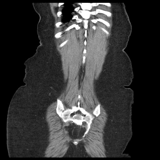 Closed loop small bowel obstruction - internal hernia (Radiopaedia 65402-74450 B 96).jpg