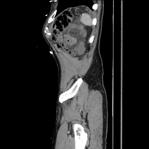 Closed loop small bowel obstruction - omental adhesion causing "internal hernia" (Radiopaedia 85129-100682 C 157).jpg