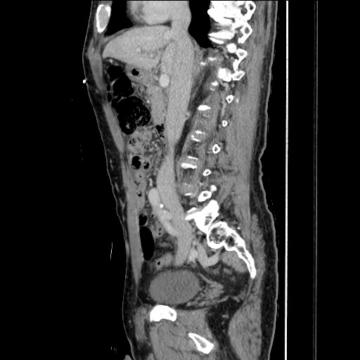 Closed loop small bowel obstruction - omental adhesion causing "internal hernia" (Radiopaedia 85129-100682 C 81).jpg