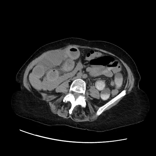 Closed loop small bowel obstruction due to adhesive band, with intramural hemorrhage and ischemia (Radiopaedia 83831-99017 Axial non-contrast 92).jpg