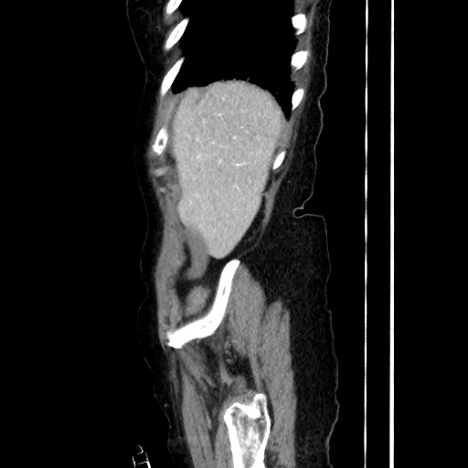 Closed loop small bowel obstruction due to adhesive band, with intramural hemorrhage and ischemia (Radiopaedia 83831-99017 D 48).jpg
