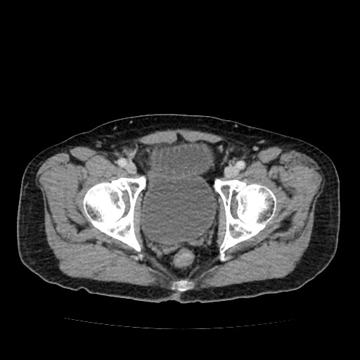 File:Closed loop small bowel obstruction due to adhesive band - U-shaped loop (Radiopaedia 83829-99012 A 66).jpg
