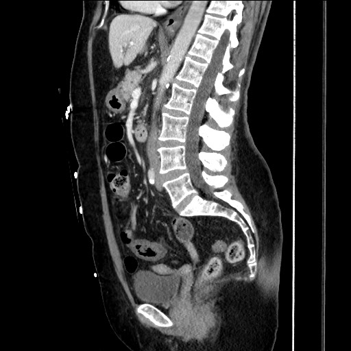 Closed loop small bowel obstruction due to adhesive bands - early and late images (Radiopaedia 83830-99014 C 93).jpg