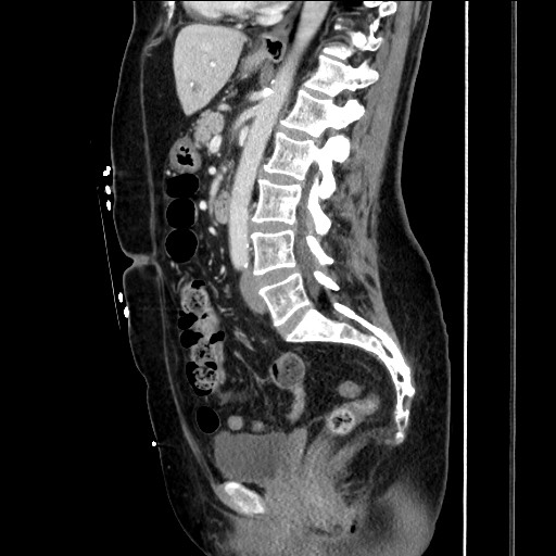 Closed loop small bowel obstruction due to adhesive bands - early and late images (Radiopaedia 83830-99014 C 98).jpg