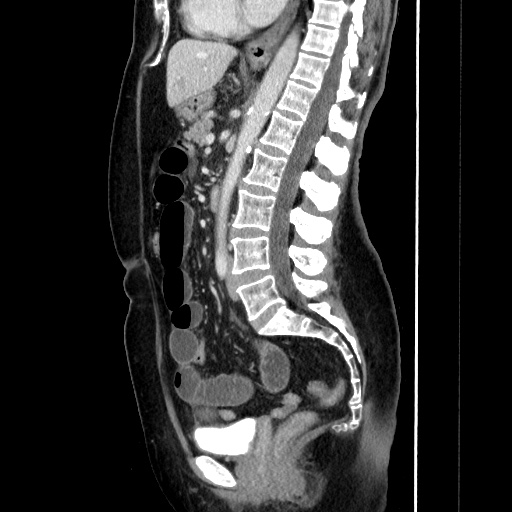 Closed loop small bowel obstruction due to adhesive bands - early and late images (Radiopaedia 83830-99015 C 93).jpg