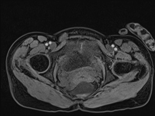 Closed loop small bowel obstruction in pregnancy (MRI) (Radiopaedia 87637-104031 G 22).jpg