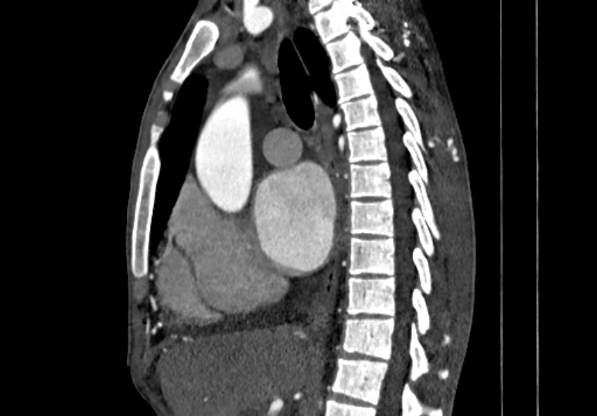 Coarctation of aorta with aortic valve stenosis (Radiopaedia 70463-80574 B 45).jpg