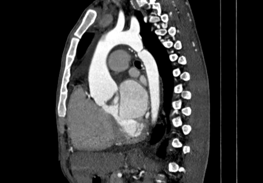 Coarctation of aorta with aortic valve stenosis (Radiopaedia 70463-80574 B 79).jpg