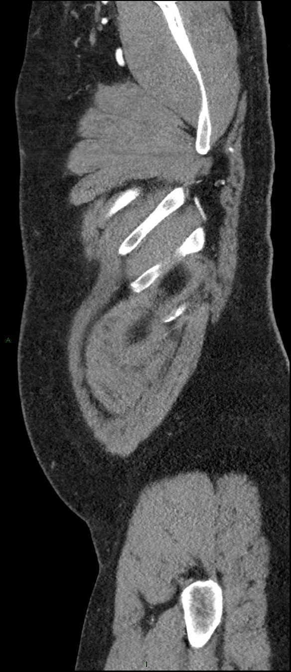 Coarctation of the aorta (Radiopaedia 74632-88521 C 11).jpg