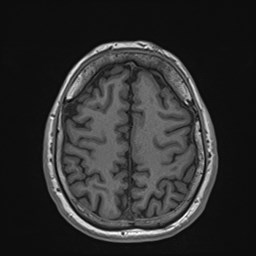 File:Cochlear incomplete partition type III associated with hypothalamic hamartoma (Radiopaedia 88756-105498 Axial T1 149).jpg