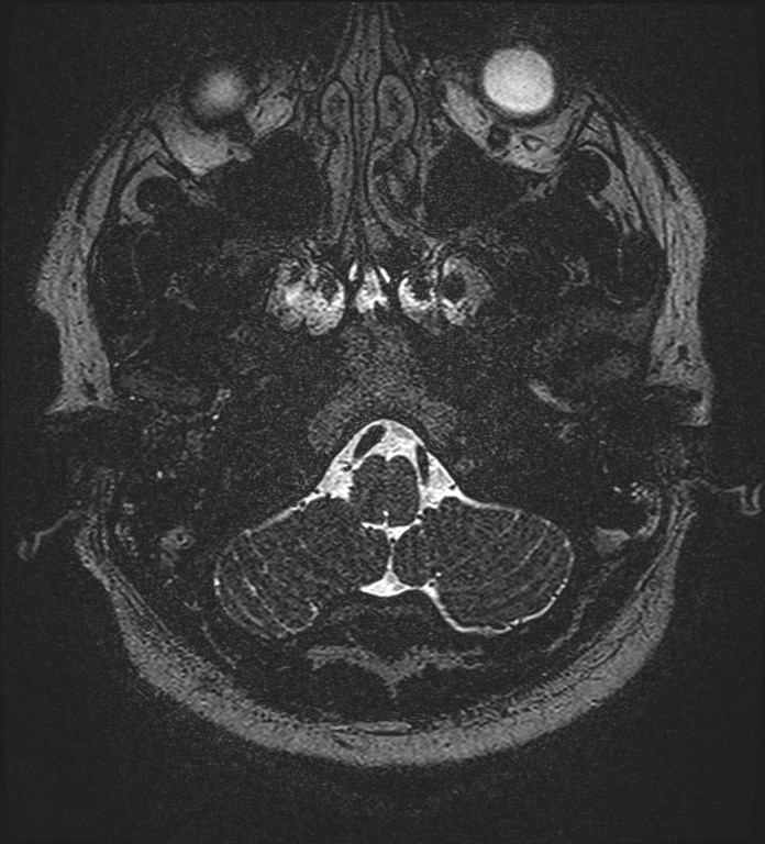 Cochlear incomplete partition type III associated with hypothalamic hamartoma (Radiopaedia 88756-105498 Axial T2 24).jpg