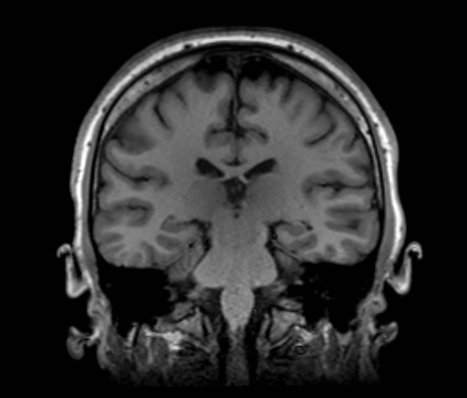 Cochlear incomplete partition type III associated with hypothalamic hamartoma (Radiopaedia 88756-105498 Coronal T1 29).jpg