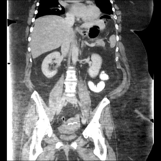 File:Collection due to leak after sleeve gastrectomy (Radiopaedia 55504-61972 B 28).jpg