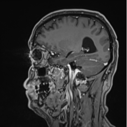 File:Colloid cyst of the third ventricle (Radiopaedia 86571-102662 Sagittal T1 C+ 54).png