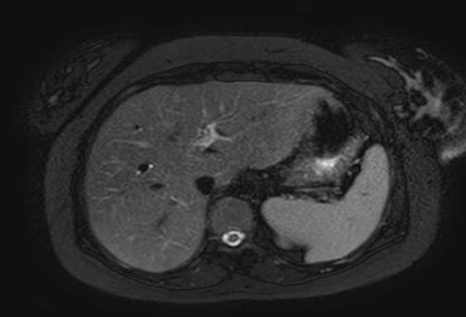 Colon adenocarcinoma with Krukenberg tumors, advanced pregnancy (Radiopaedia 67279-76645 Axial T2 SPAIR 69).jpg