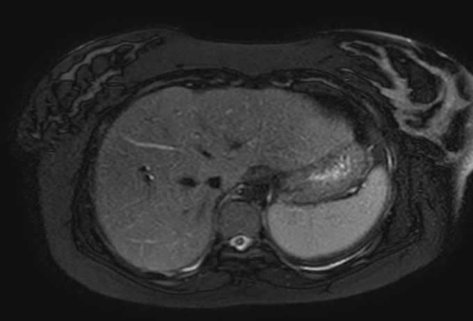 File:Colon adenocarcinoma with Krukenberg tumors, advanced pregnancy (Radiopaedia 67279-76645 Axial T2 SPAIR 74).jpg