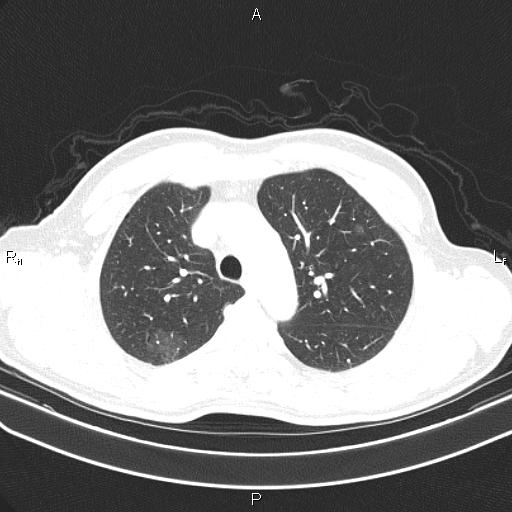 File:Colon cancer (Radiopaedia 85663-101443 Axial lung window 18).jpg