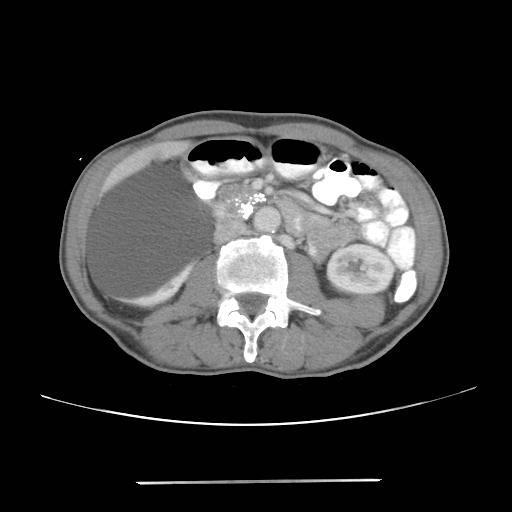 Colon cancer with calcified liver metastasis (Radiopaedia 74423-85307 A 34).jpg