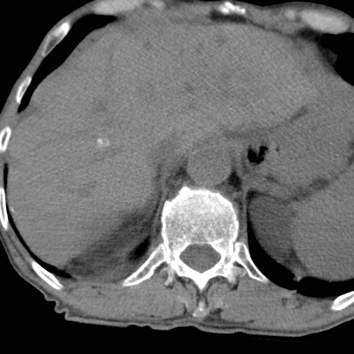 Colon cancer with calcified liver metastasis (Radiopaedia 74423-85309 Axial non-contrast 20).jpg