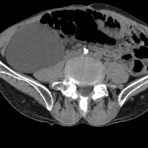 Colon cancer with calcified liver metastasis (Radiopaedia 74423-85309 Axial non-contrast 69).jpg